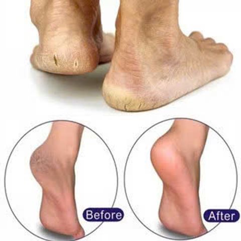 Kem Dưỡng Mềm Mịn, Chống Nứt Nẻ Gót Chân Fixderma Foot Cream 60g