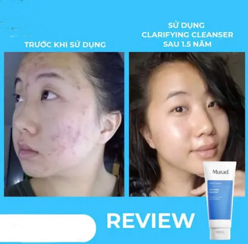 [Hàng C.Ty] Gel rửa mặt cho da mụn Murad Acne Control Clarifying Cleanser 200ml