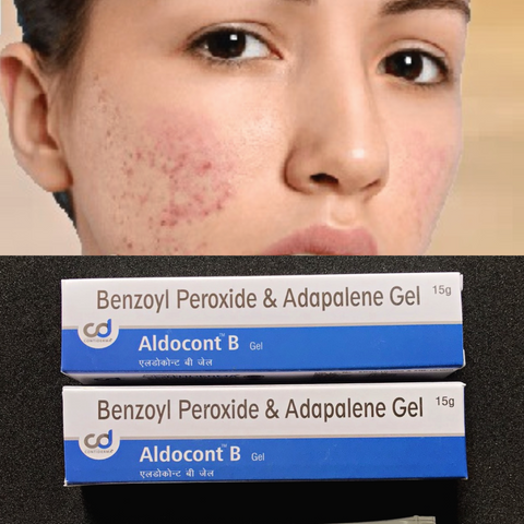 Gel Trị Mụn Aldocont B - BPO 2.5% và Adapa 0.1% ngăn ngừa mụn trứng cá, làm sạch lỗ chân lông - 15g