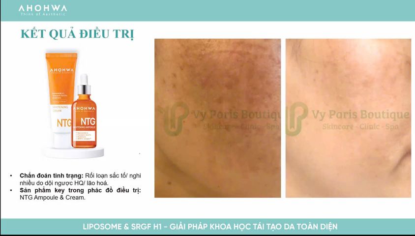 Tinh Chất Dưỡng Trắng Mờ Thâm Nám Ahohwa Whitening Ampoule NTG 30ml - Serum Làm Sáng Da Hiệu Quả, Phù Hợp Mọi Loại Da