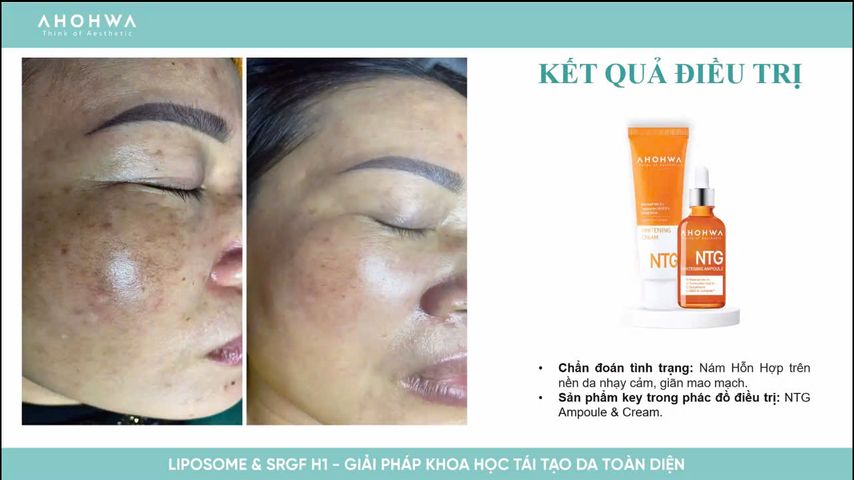Tinh Chất Dưỡng Trắng Mờ Thâm Nám Ahohwa Whitening Ampoule NTG 30ml - Serum Làm Sáng Da Hiệu Quả, Phù Hợp Mọi Loại Da