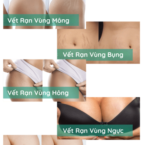 Kem tr.ị rạn da và chống sẹo cho mẹ bầu và sau sinh StretcHeal hàng Mỹ 180ml