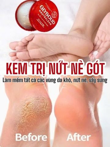 Kem Giảm Nứt Nẻ Gót Chân Glysolid Hautbalsam Đức 100ml