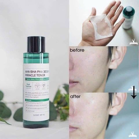 Nước hoa hồng hỗ trợ mụn Some By Me 30days Miracle toner - 150ml