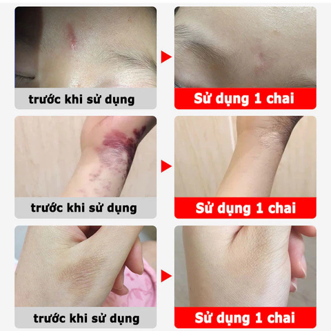 Kem Xóa Sẹo Dermatix Ultra 20g - Giảm Mờ Sẹo Phẫu Thuật, Dưỡng Ẩm, Thẩm Thấu Nhanh, An Toàn Cho Người Lớn và Trẻ Em Từ 6 Tháng