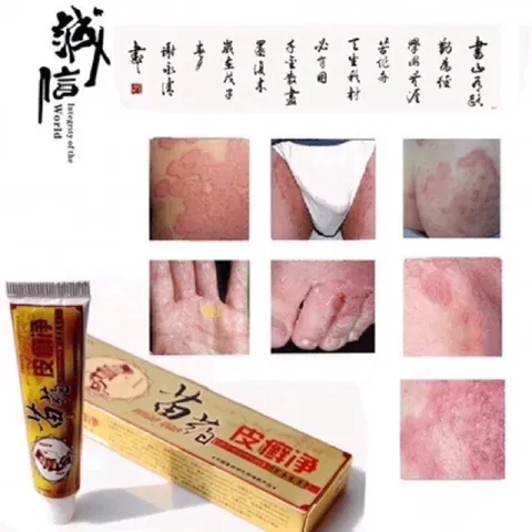 Kem Bôi Da Liễu CHA-REN - Giảm Ngứa, Hắc Lào, Vảy Nến, Lang Ben - Hàng Xuất Khẩu Châu Âu Chất Lượng Cao