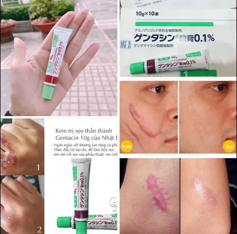 Kem Giảm Mờ Sẹo Gentacin Sulfate - 10G