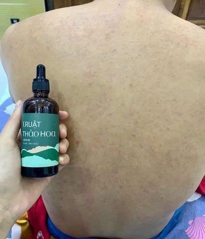 Truật Thảo Hoa D'Vi Nature - Sản Phẩm Chăm Sóc Da Hỗ Trợ Giảm Mụn Lưng & Mụn Ngực Từ Thiên Nhiên, An Toàn Và Hiệu Quả