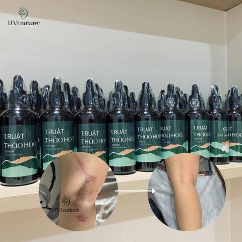 Truật Thảo Hoa D'Vi Nature - Sản Phẩm Chăm Sóc Da Hỗ Trợ Giảm Mụn Lưng & Mụn Ngực Từ Thiên Nhiên, An Toàn Và Hiệu Quả