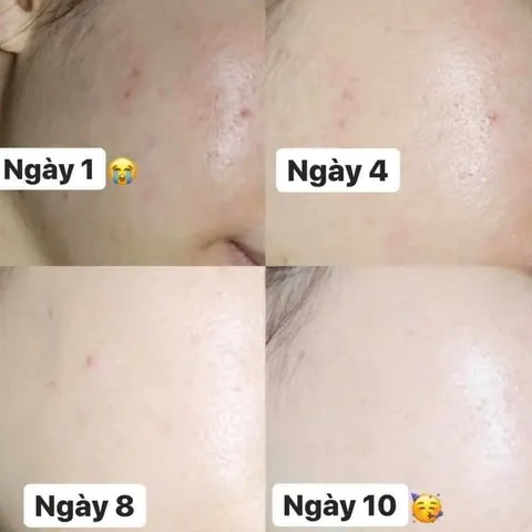Kem Dưỡng Da A313 Pommade Retinol Cream - Trẻ Hóa Da, Giảm Mụn, Mờ Nếp Nhăn - Sản Phẩm Nội Địa Pháp 50g