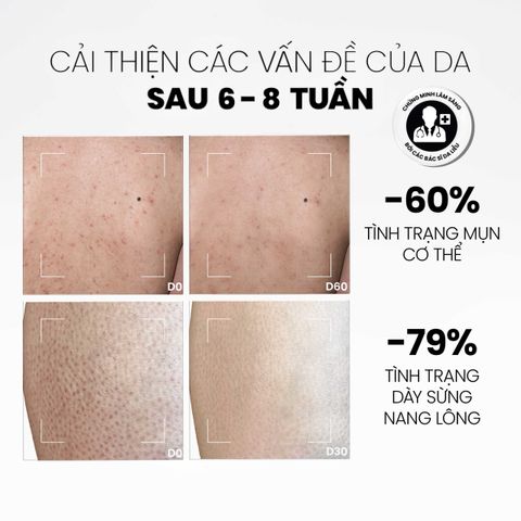 Sữa Tắm Giảm Mụn & Tẩy Tế Bào Chết MD Care - Chăm Sóc Da Mịn Màng Với AHAs & BHA, Phù Hợp Cho Da Dầu & Da Mụn