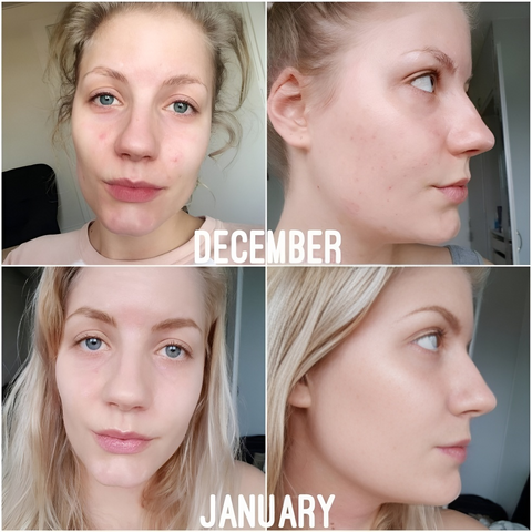 Serum chống viêm, giảm kích ứng dành cho da mụn The Ordinary Niacinamide 10% + Zinc 1% 30ml 240846