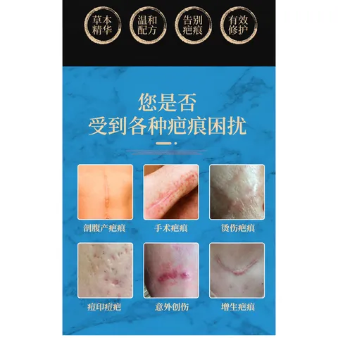 Kem Xóa Sẹo 20g Dermatix Ultra - Gel Mờ Hiệu Quả Vết Sẹo Lâu Năm, Phẫu Thuật, Bảo Vệ Da Uv, Dưỡng Ẩm Silicon Polymer