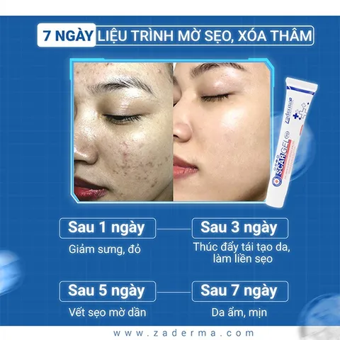 ZADERMA SCAR GEL 7D (7g) - Gel Mờ Sẹo Hiệu Quả, Cải Thiện Sẹo Sau Mụn Chỉ Sau 7 Ngày, Giúp Da Mịn Màng Tự Nhiên