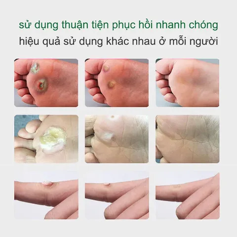 Kem Tẩy Mụn Cóc 10g - Gel Tẩy Nốt Ruồi Hiệu Quả 7 Ngày, Làm Sạch Da Mịn Màng, Giảm Sẹo Sẫm Màu, Dưỡng Ẩm Chất Lượng