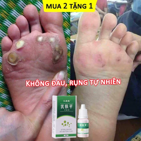Kem Tẩy Mụn Cóc 10g - Gel Tẩy Nốt Ruồi Hiệu Quả 7 Ngày, Làm Sạch Da Mịn Màng, Giảm Sẹo Sẫm Màu, Dưỡng Ẩm Chất Lượng