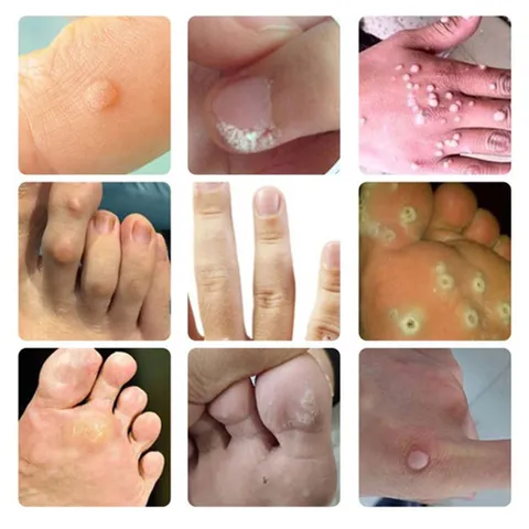 Kem Tẩy Mụn Cóc 10g - Gel Tẩy Nốt Ruồi Hiệu Quả 7 Ngày, Làm Sạch Da Mịn Màng, Giảm Sẹo Sẫm Màu, Dưỡng Ẩm Chất Lượng