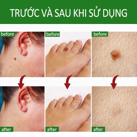 Kem Tẩy Mụn Cóc 10g - Gel Tẩy Nốt Ruồi Hiệu Quả 7 Ngày, Làm Sạch Da Mịn Màng, Giảm Sẹo Sẫm Màu, Dưỡng Ẩm Chất Lượng