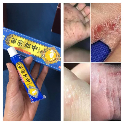 Kem Bôi Đông Y Chữa Nấm Ngứa 15g - Hiệu Quả Nhanh Chóng, Điều Trị Viêm Da, Dị Ứng và Nấm Tay Chân
