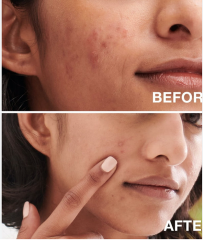 Sữa rửa mặt giảm mụn Neutrogena Oil Free Acne Wash 175ml  246275