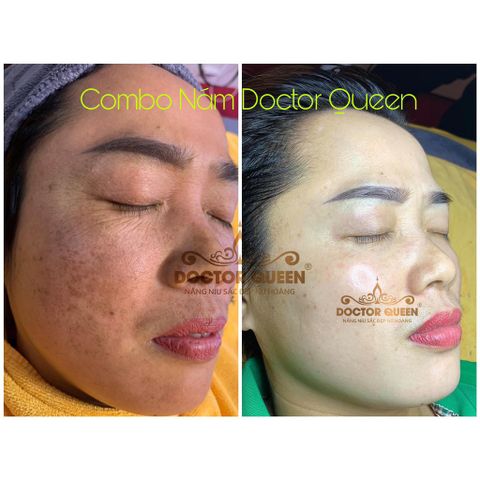 SERUM DETOX MỤN DOCTOR QUEEN - (Ngừa tất cả các loại mụn,thâm,. đào thải phục hồi tái tạo da,da yếu, giãn mao mạch,...)