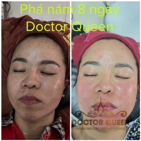 Bộ 3 Viên Uống Trị Nám Doctor Queen - Phá Nám, Trắng Da, Hiệu Quả Trong 8 Ngày - Đẹp Da, Ngăn Ngừa Tàn Nhang