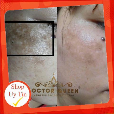 Kem Nám Doctor Queen - Kem Chăm Sóc Da Làm Sáng, Ngừa Nám Chân Sâu Và Tàn Nhang, Giải Pháp Cho Da Sáng Mịn