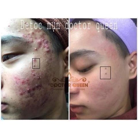Detox hỗ trợ mụn, da không đều màu, sáng trắng da doctor queen