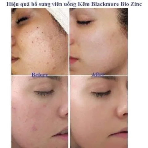 Viên uống bổ sung Kẽm Blackmores 84 viên - Hỗ trợ làm đẹp da, ngừa mụn và dưỡng da khỏe mạnh từ Úc