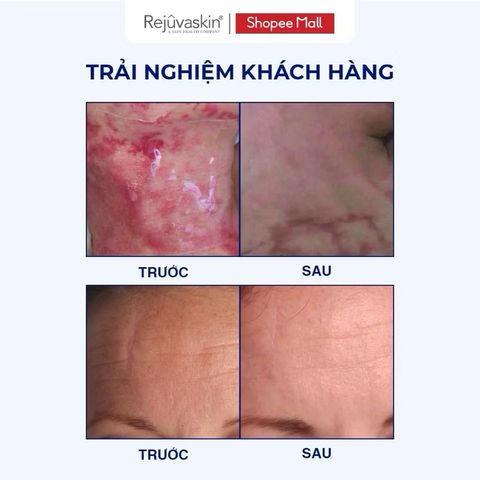 Miếng Dán Xóa Sẹo Lồi/Phì Đại Rejuvaskin Scar FX 10x20cm - Silicone Y Tế Hỗ Trợ Làm Mờ Sẹo, An Toàn Cho Mọi Loại Da