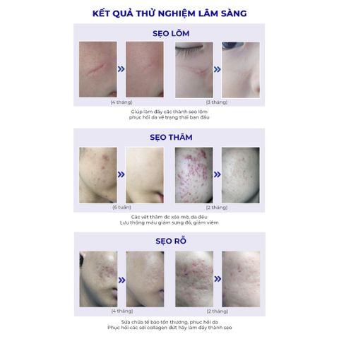 Kem Xóa Sẹo Thâm Scar Esthetique 60ml - Giúp Lấp Đầy Sẹo Rỗ, Sẹo Lõm, Chăm Sóc Da Mặt Từ Rejuvaskin USA