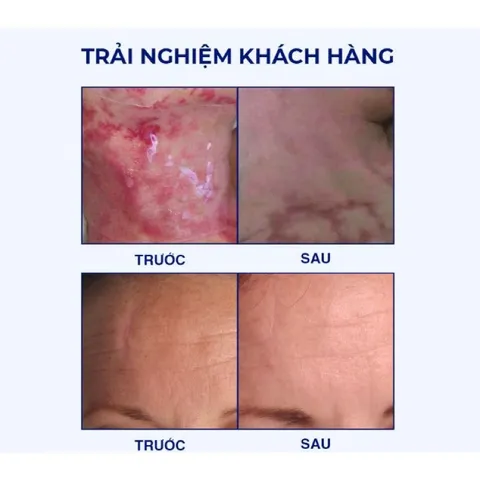 Miếng Dán Sẹo Lồi Scar FX 25x30cm Rejuvaskin - Giúp Làm Mờ và Xẹp Sẹo Phì Đại, An Toàn cho Mọi Loại Da, Sản Xuất tại Mỹ