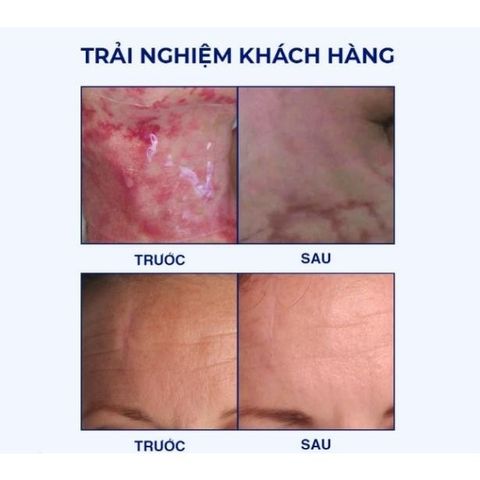 Miếng Dán Hỗ Trợ Xóa Mờ Sẹo Lồi REJUVASKIN Scar FX 2,5x55cm - Giúp Làm Phẳng Sẹo Sau Phẫu Thuật, Bỏng, Tăng Cường Độ Mềm Mịn Da