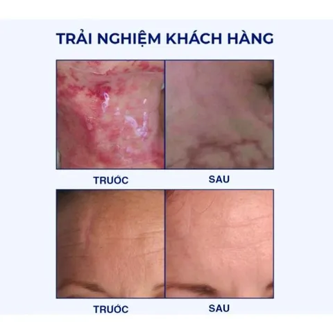 Miếng Dán Xóa Mờ Sẹo Lồi REJUVASKIN Scar FX - Silicone Y tế Chăm Sóc Da, Phục Hồi Tổn Thương, Che Phủ Hoàn Hảo
