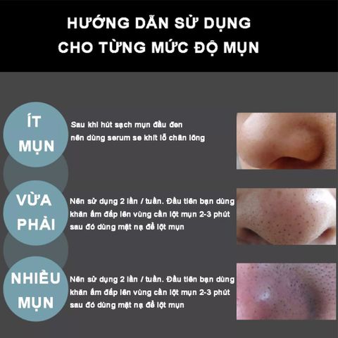 Gel Hút Mụn Than Tre Hoạt Tính KONE 50ml - Mặt Nạ Lột Mụn Cám & Đầu Đen, Sạch Da, Tặng Cọ, An Toàn Cho Da Nhạy Cảm