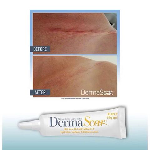 Gel Bôi Sẹo DermaScar Silicone Plus E 15g - Gel Chăm Sóc Da Mịn Màng với Vitamin E 10% cho Vết Sẹo Lồi Hồi Phục Hiệu Quả
