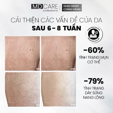 Sữa Dưỡng Thể MD CARE Chống Mụn - Dưỡng Ẩm Với 8% Azeclair & 5% Niacinamide 200ml, Giúp Làm Dịu Da Mụn, Trị Mụn Lưng Ngực