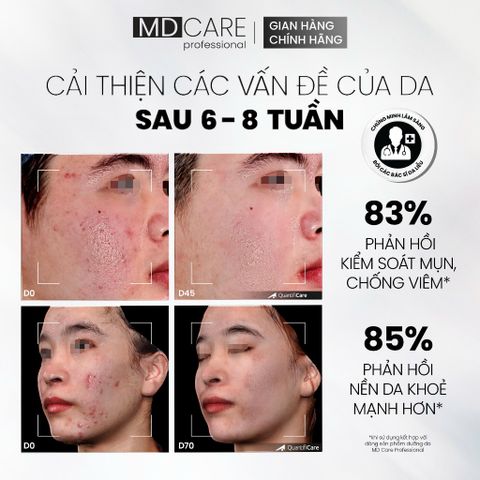 Sữa Rửa Mặt Bọt MD CARE BHA Cho Da Dầu Mụn Nhạy Cảm 200ml - Giải Pháp Làm Sạch Sâu, Kiểm Soát Dầu và Ngăn Ngừa Mụn
