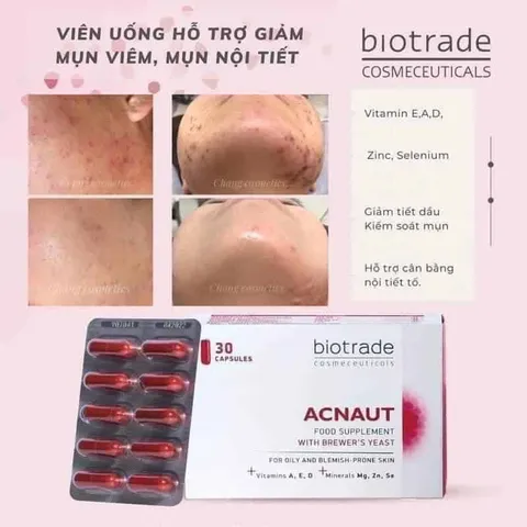 Viên Uống Giảm Mụn Biotrade Acnaut - Thực Phẩm Chức Năng 30 Viên, Hỗ Trợ Da Sáng Khỏe, Giảm Thâm, Kiềm Dầu