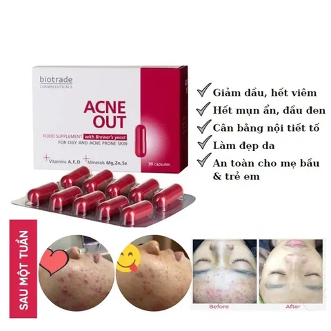 Viên Uống Giảm Mụn Biotrade Acnaut - Thực Phẩm Chức Năng 30 Viên, Hỗ Trợ Da Sáng Khỏe, Giảm Thâm, Kiềm Dầu