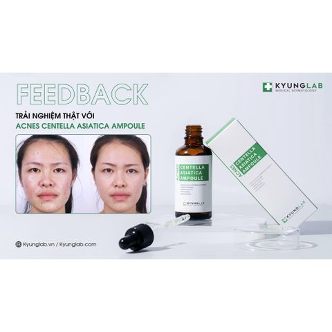 Serum Kyung Lab Acnes Centella Asiatica 50ml - Giảm mụn, kiềm dầu, mờ thâm cho da dầu và hỗn hợp - Hàng nhập khẩu chính hãng Hàn Quốc
