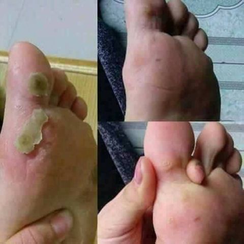 [Chuẩn Viện Da Liễu] Loại Bỏ Mụn Cơm - Mụn Cóc - Mắt Cá Chân - Acid Trivhloracetic 80%