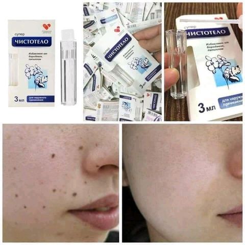 Gel tẩy nốt ruồi và mụn cóc Dvelinil Nga 3ml - Giải pháp làm sạch da hiệu quả cho nốt ruồi và mụn cơm