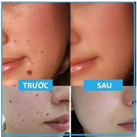 Gel tẩy nốt ruồi và mụn cóc Dvelinil Nga 3ml - Giải pháp làm sạch da hiệu quả cho nốt ruồi và mụn cơm