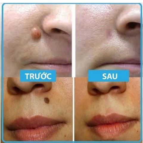 Gel tẩy nốt ruồi và mụn cóc Dvelinil Nga 3ml - Giải pháp làm sạch da hiệu quả cho nốt ruồi và mụn cơm