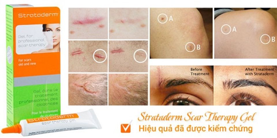 Strataderm Gel Hỗ Trợ Giảm Sẹo - Hiệu Quả Trong Việc Làm Mờ Sẹo Lâu Năm, Không Gây Ngứa, Dễ Dàng Sử Dụng
