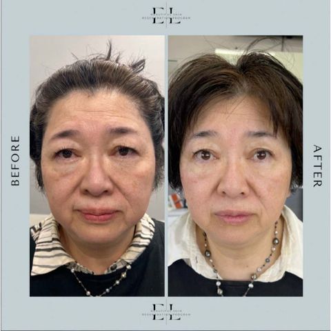 Sữa Rửa Mặt Dịu Nhẹ Hyaestic 1% BHA - Làm Sạch Sâu, Giảm Bã Nhờn, Dưỡng Ẩm Cho Mọi Loại Da 150ml