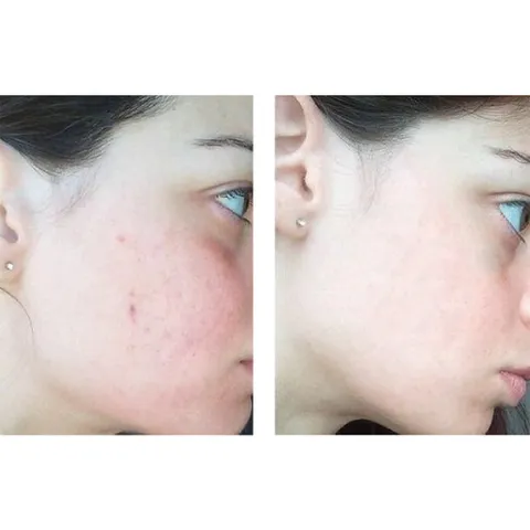 GEL CHẤM MỤN HD DERMA HD CEUTICALS - Kiểm Soát Bã Nhờn, Giảm Mụn Trứng Cá, Làm Dịu Da, Chống Viêm, Chống Oxy Hóa