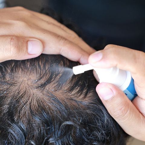 Xịt mọc tóc Minoxidil 5% Pháp