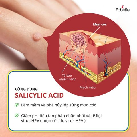 Miếng Dán MỤN CÓC Mụn Cơm Corn plaster KangDi Fobe N1 - hộp 6 miếng